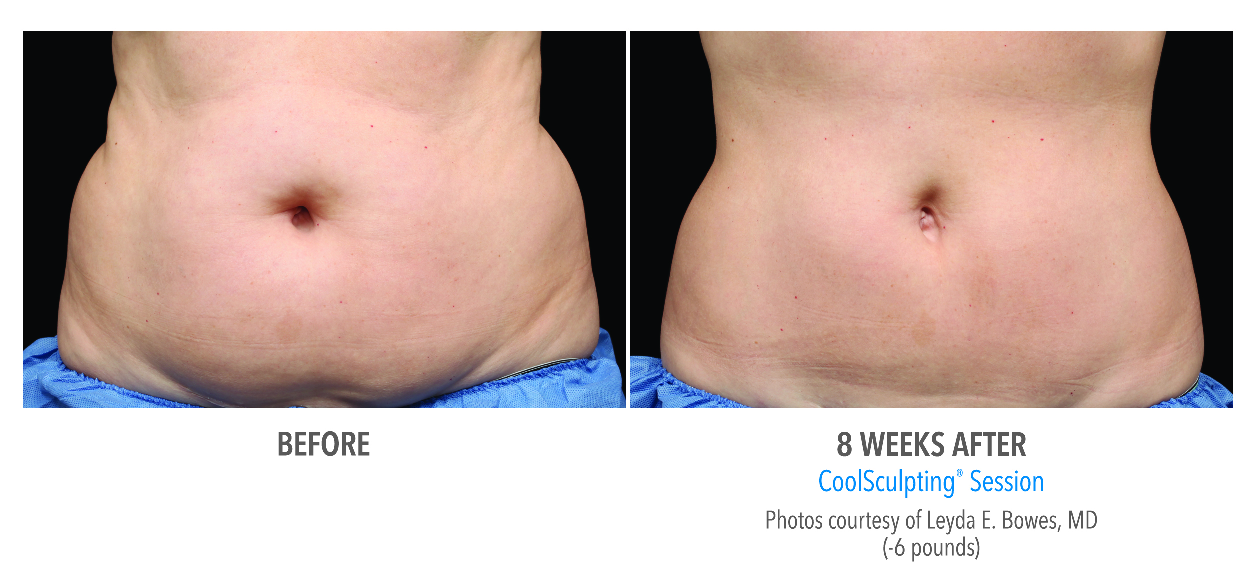 CoolSculpting Fat Reduction In Gainesville FL